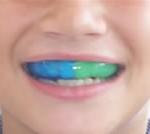 front-mouthguards
